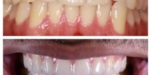 Invisalign Antes e Depois