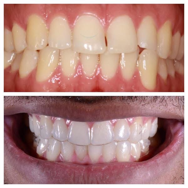 Invisalign Antes e Depois