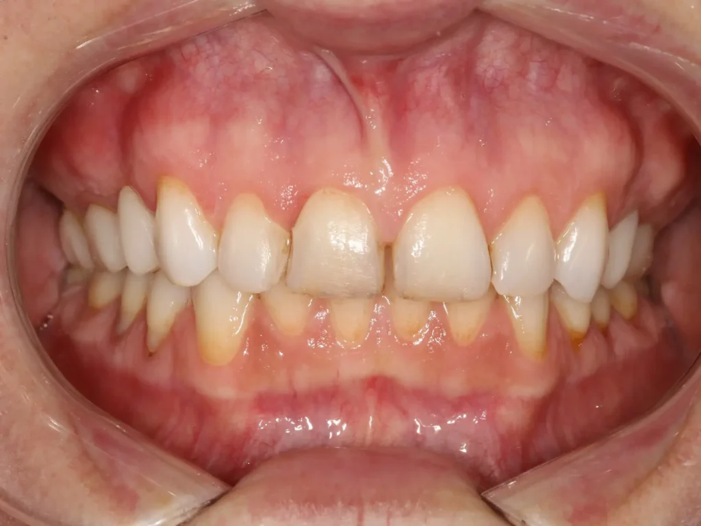 Sorriso com Diastema