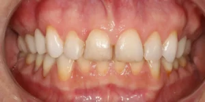 Sorriso com Diastema