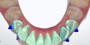 Invisalign como funciona
