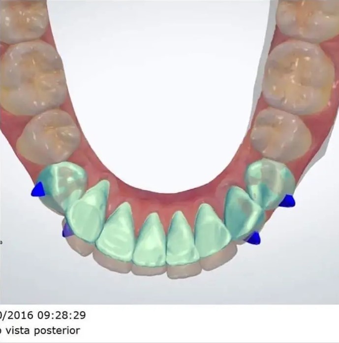 Invisalign como funciona