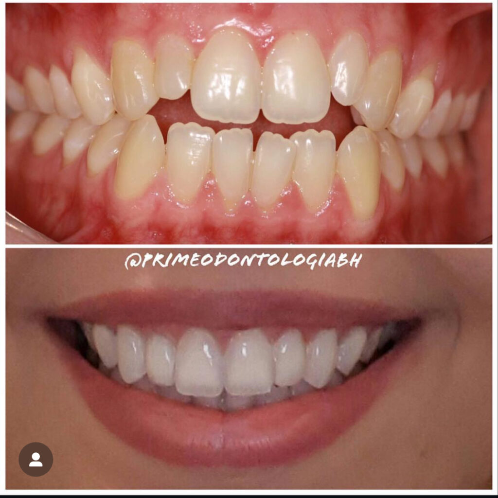 Invisalign quando acaba