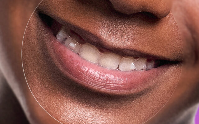 Invisalign como funciona?