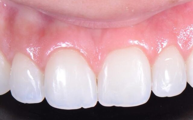 Sorriso após o tratamento com o Invisalign
