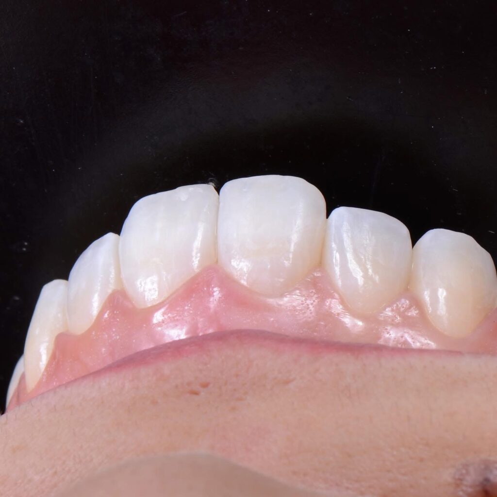 Sorriso após o Invisalign