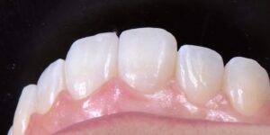 Sorriso após o Invisalign